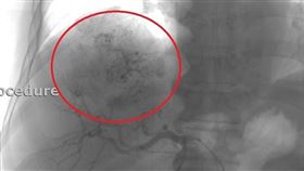 肝癌不能開刀別怕　還有這些治療方式（南投醫院提供）