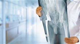 一名20歲女大生因上學時發生嚴重車禍，造成左側骨盆粉碎性骨折在術後復健期間髖關節疼痛加劇，再次經過X光檢查發現是髖關節創傷後「股骨頭壞死」及關節炎，必須進行人工髖關節手術。骨盆骨折術後常有嚴重骨頭變形及骨頭缺損，甚至關節沾黏、肌肉萎縮的狀況也不少見。黃贊文醫師指出，為這類病人安排置換人工關節時，先前用來固定骨折的鋼釘、鋼板，容易造成手術困難，因此進行人工關節置換手術的難度不低。