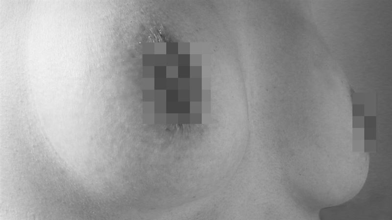 乳頭冒「血色分泌物」　小心婦女殺手