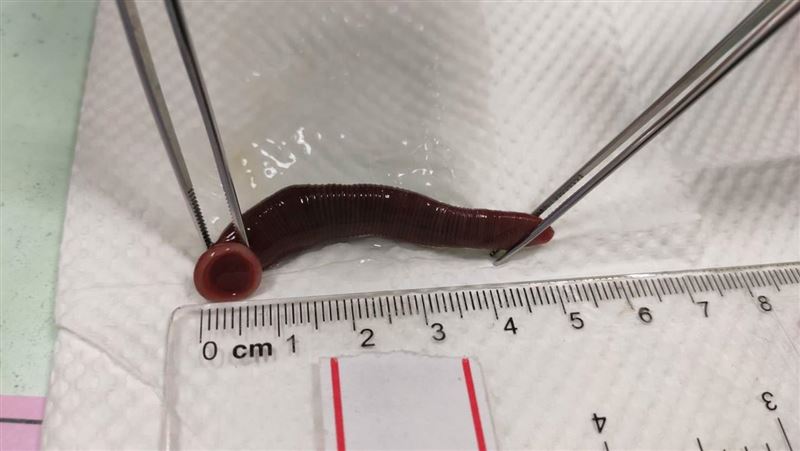 男喝溪水「鼻腔噴血」　竟夾出6公分水蛭