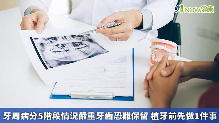 牙周病分5階段　植牙前先做1件事