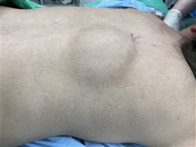 婦人不敢穿緊身衣　求診掀衣背瘤已8公分（圖／翻攝畫面）