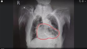 姜冠宇今（2）天在臉書分享一張胸部X光片，他說，這個就是經典的『咳到胃翻出來』，貼文一出引發討論。（圖／翻攝自姜冠宇臉書）