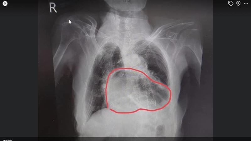 醫曝驚人X光照片：這就是咳到胃翻出來