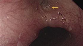 1103食道廔管(圖/Gastroenterology期刊)