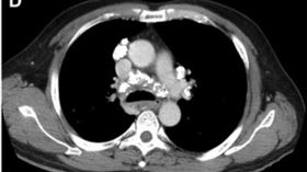 1103塵肺症電腦斷層影像(圖/Gastroenterology期刊)