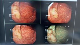 大腸鏡(讀者提供)