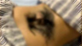 17歲妹子腰長詭異黑毛！治療怪病「須磨掉骨頭」　出現2症狀快就醫