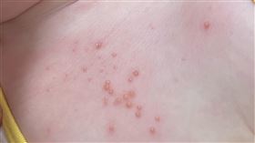 小孩身上長密集珍珠？醫急喊恐染「1病毒」　兄弟姊妹也會中招