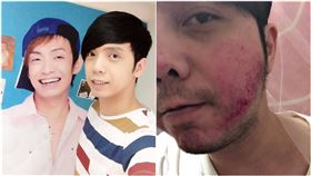 小炳為已故大炳和陌生人打架　臉腫成豬頭 （圖／翻攝自小炳臉書）