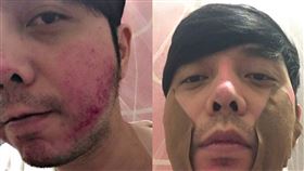 藝人小炳替亡兄大炳討公道，和3路人互毆臉部掛彩。（圖／小炳提供）