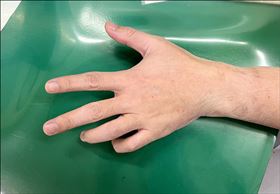 鷹爪,隧道症候群(圖/院方提供)