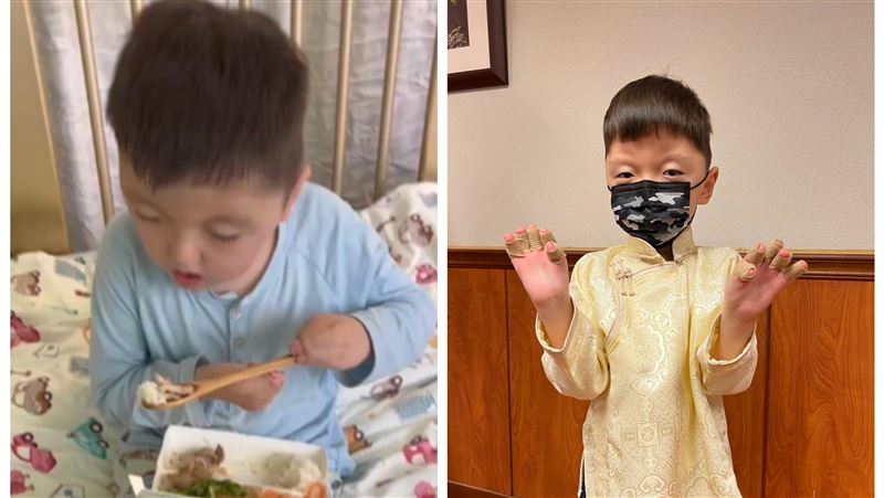 罕病童「湯匙手」分離　10手指切5歲蛋糕