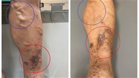 廚師，久站，下肢靜脈曲張，床單爆血　（圖／長安醫院提供）