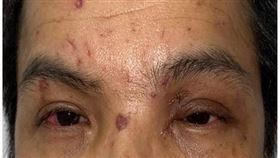 台中榮總，卡式瓦斯爐氣爆，金屬碎片炸飛，雙眼噴濺刺傷，眼角膜出血，熊貓眼，視力0.2 (圖／台中榮總提供)