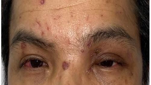 瓦斯罐氣爆！男子被炸成熊貓眼視力剩0.2
