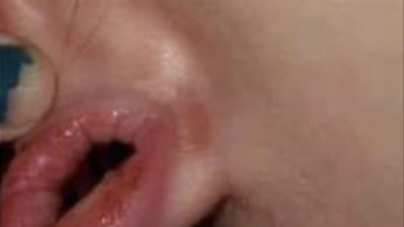 恩愛玩過頭！她耳洞腫如「魷魚圈」崩潰