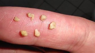 他挖出6顆「喉嚨珍珠」　網：好臭的照片