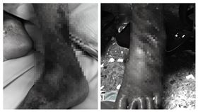 長照員「燙傷9旬嬤」裝傻離開！引發敗血症2天猝逝　孫女淚曝傷口照