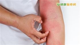 異位性皮膚炎病友的皮膚常有搔癢、紅腫、發炎、流出組織液與脫屑等情況，嚴重時甚至會皮膚龜裂合併傷口感染。