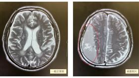 硬腦膜下出血(長安醫院提供)