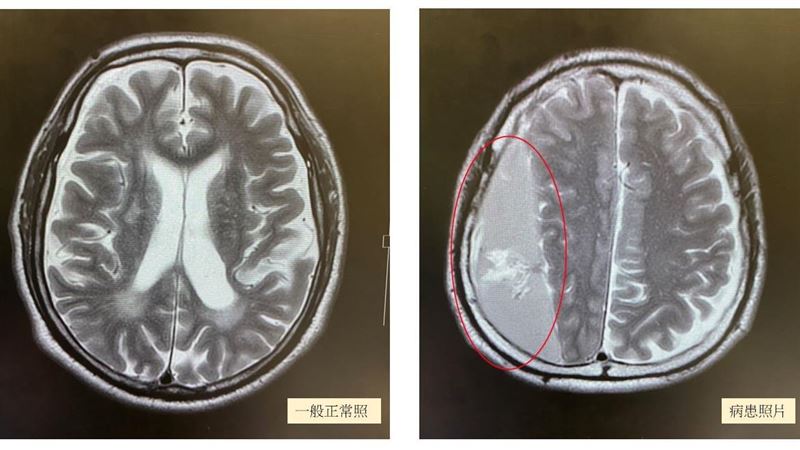 驚！半邊身體無力竟是「硬腦膜下出血」