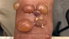 1115接觸性皮膚炎(趙昭明提供)