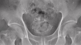 （圖／翻攝自Urology Case Reports）