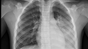 一名八歲男童因呼吸道融合病毒（RSV）合併肺炎鏈球菌及鼻病毒的感染，造成左側大葉性肺炎，胸部X光照片顯示左邊肺部位置幾乎變白了。（圖／翻攝自花蓮慈濟醫院臉書）
