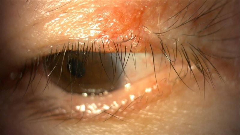 眼睛紅腫癢1年　醫檢查眼瞼爬2百隻寄生蟲