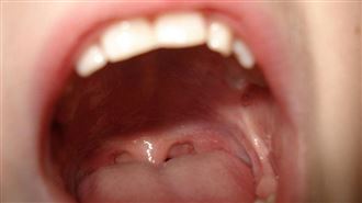 以為小毛病　口腔3徵兆「癌王風險飆3倍」
