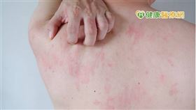 疫情爆發以來，有不少患者因為施打疫苗或是染疫後造成皮膚起紅疹、膨疹或發癢…等蕁麻疹表現。