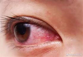 20多歲女「隱形眼鏡戴10年」！醫檢查驚：眼角膜長滿新生血管（圖／翻攝自深圳特區報）