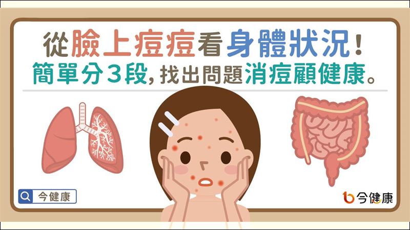 從痘痘看出身體狀況！簡單分３段找出問題