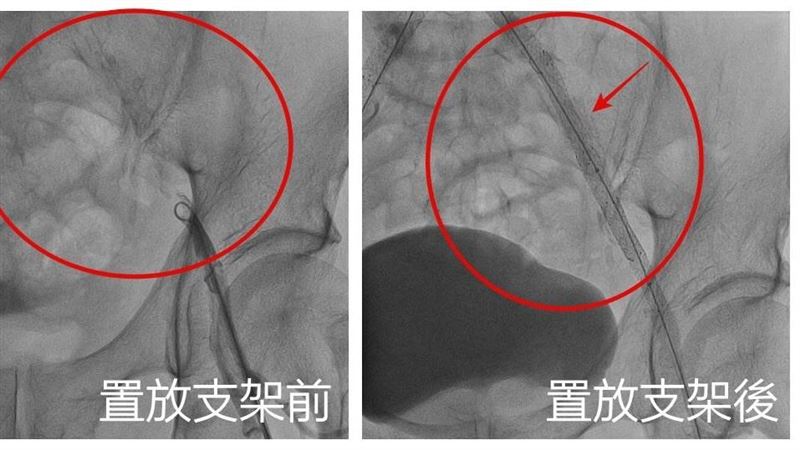 六旬男腳跛給醫摸完　術後那話兒重新升旗