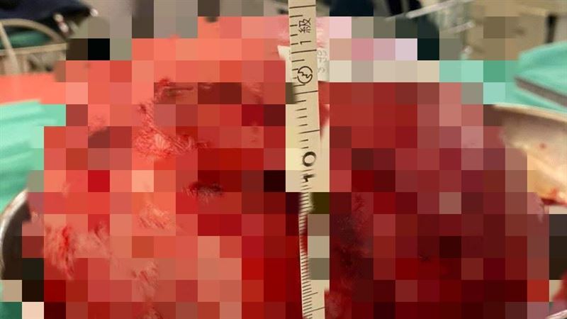 她掉出「如仙草凍血塊」醫：恐2食物害的