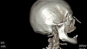 電腦斷層顯示，患者黃女士的鼻骨上方有一塊突起物。（圖／彰化醫院提供）