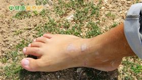 正逢秋冬季節，天氣較於乾燥加上缺乏紫外線，導致較難抑制免疫反應，因此也是進入乾癬症狀容易復發時期，除了靠平時保養，在治療上，如何將發炎反應抑制下來才是關鍵。