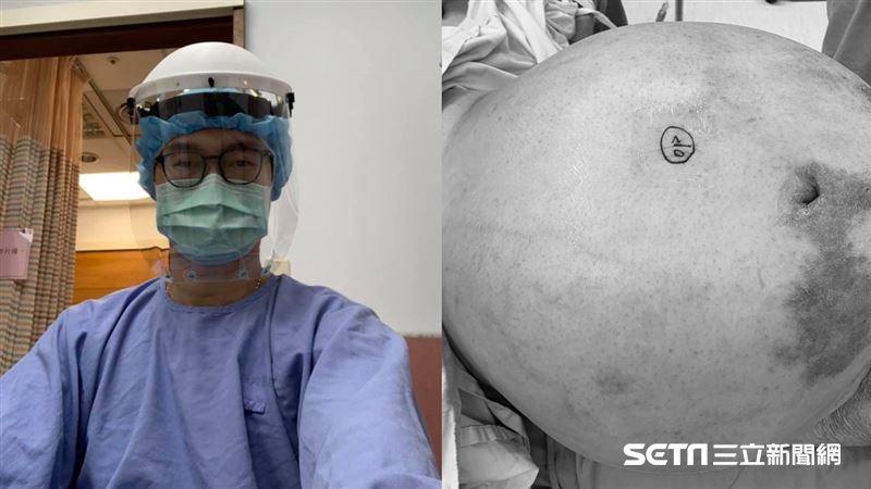 腹脹半年驚見18公斤卵巢瘤　醫揭沉默殺手