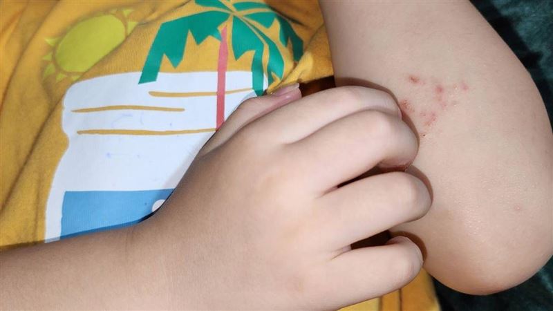 5歲童皮膚癢「抓到流膿」！醫籲3招避誘發