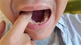 衛生福利部,台北醫院,耳鼻喉科,李家萱,口腔癌
圖／台北醫院、資料照