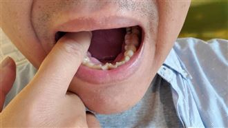 不菸不酒也中！日常「1行為」恐罹口腔癌