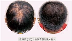 台南,安南醫院,圓禿,鬼剃頭,女國中生,類固醇,自體免疫,髮量