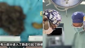 中國一名14歲的少女胃部竟藏有約3公斤的胃髮石。（圖／翻攝自《白鹿視頻》）