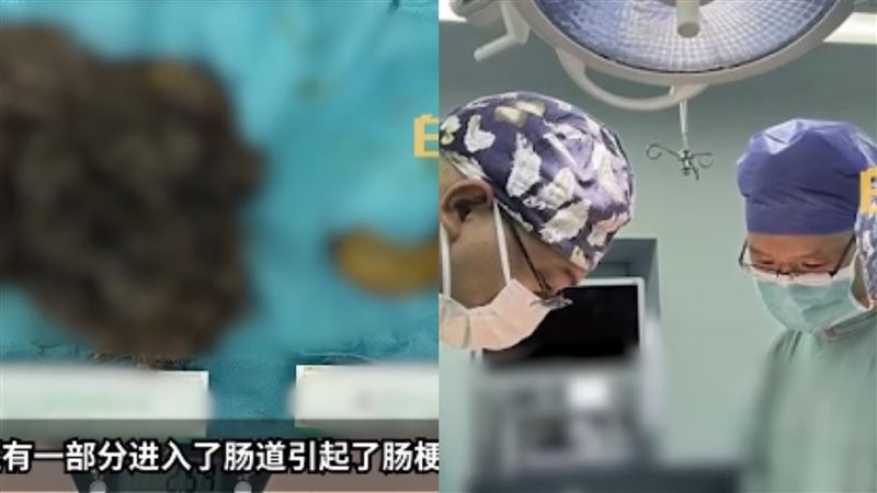 少女禿頭沒食欲！醫檢查胃見3公斤胃髮石