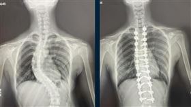 台中榮總，重度脊椎側彎，矯正手術，擴增實境（AR）眼鏡，術中導航，中榮總神經外科主任楊孟寅 (圖／台中榮總提供)