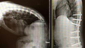 長期彎腰駝背　27歲男身高竟少了45公分（圖／台北慈院提供）