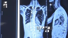  校隊球員骨頭 脊椎 消失 罕病 （圖／翻攝自微博）