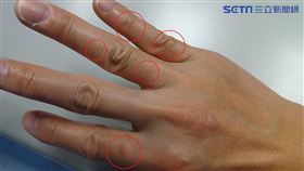 汗皰疹(資料照)