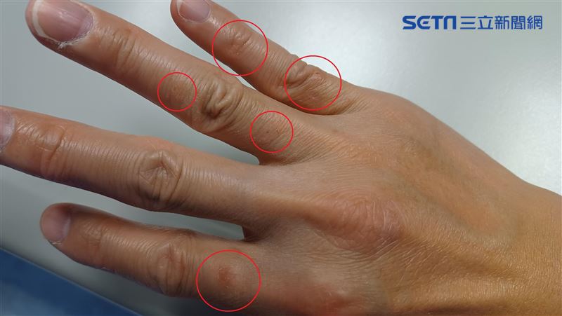 手上「小珠珠」愈抓愈癢　情緒竟是誘因